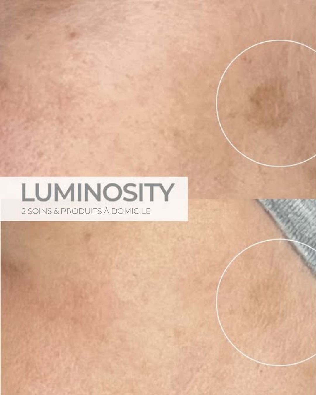 Comparaison photographique Luminosity fournie par ANESI : pigmentation avant et après deux soins et une routine à domicile